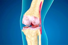 Joint Pain? There is a Simple Home Remedy! Without Surgery!