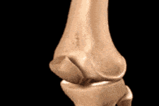 Doctors Stunned: One Simple Move Ends Years of Arthritis Pain!