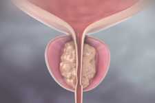 Urologist: Do This if You Have Enlarged Prostate (Watch)