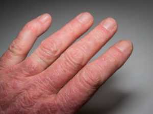 What is Psoriatic Arthritis? See Indicators (Some May Surprise)