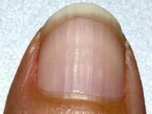 Plaque Psoriasis Common Signs - Most Wish They Hadn't Ignored