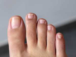 Simple Way to Reduce toenail fungus? (Watch)