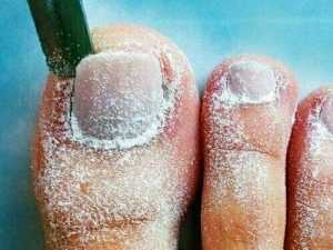 Do This if You Have Toenail Fungus