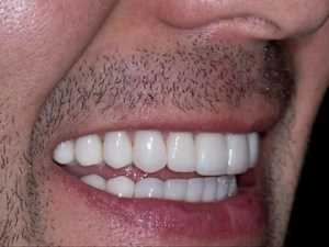 Gum Disease or Tooth Decay? Try This Tonight (It's Genius)