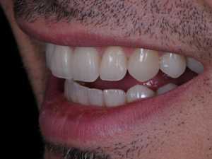 Gum Disease or Tooth Decay? Try This Tonight (It's Genius)