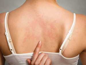 Hepatitis |How to Recognize and How It is Treated, Treatment