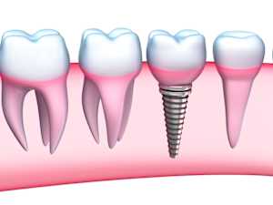 Here's What Full Mouth Dental Implants Should Cost You in 2022