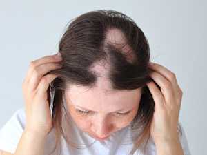 What Causes Spotty Hair Loss? Indicators You Might Not Know