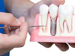 Peoria: Actual Whole Mouth Dental Implant Cost in 2022