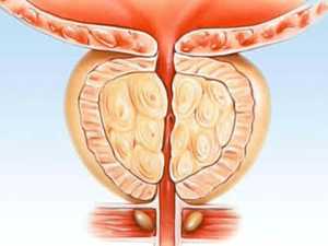 Top Urologists: 90% of Men Don't Know This Way to Shrink Your Prostate (Watch)