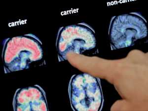 Mystery Solved: Dementia Linked to This Everyday Habit. Do You Do It?