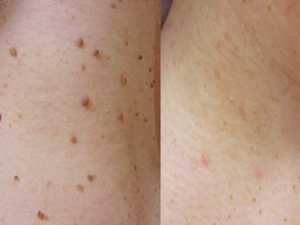 Why Do Skin Tags Keep Appearing? The Hidden Reason Nobody Talks About