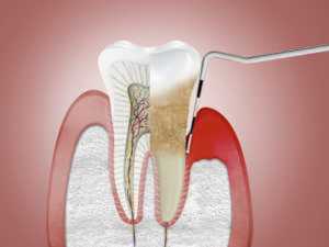 將其添加到牙膏中，幾天內即可使牙齦再生