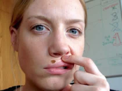 Removing Moles and Skin Tags Has Never Been Easier