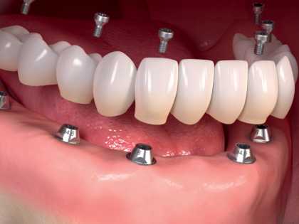This is What Full Mouth Dental Implants Should Cost You in 2023