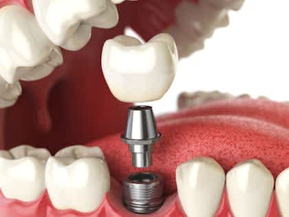 Search For least expensive dentures and implants near me