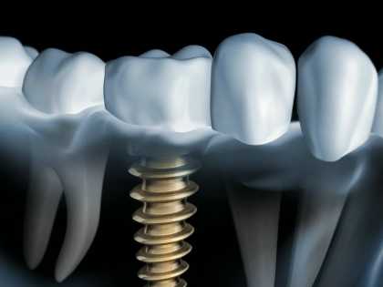Dental Implants Are Now Covered by the Nhs - Apply Now