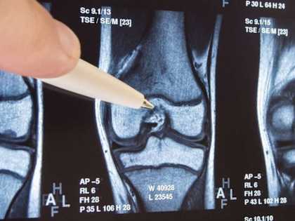 Bone on Bone Joints? Try This 15 Second Solution (Watch)