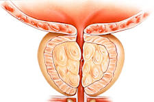 New Method Shrinks Enlarged Prostate (It's Genius)