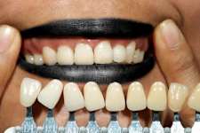 Here Is What Full Mouth Dental Implants Should Cost You In 2023