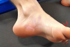 When Neuropathy Hits, Try This (It's Genius!)