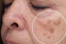 MD: Do This Immediately If You Have Dark Spots (It's Genius!)