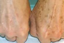 MD: If You Have Dark Spots, Do This Immediately (It's Genius!)