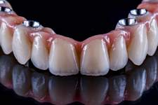 Here is the Cost of One Day Full Mouth Dental Implants in 2023!