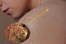 If You Find Such Papillomas on Your Body, Be Careful!