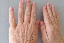 If You Find Such Papillomas on Your Body, Be Careful!