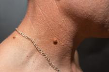 If You Find Such Papillomas on Your Body, Be Careful!