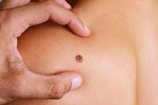 If You Have Papillomas on Your Neck or Armpits, Read This!