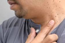 If You Find Such Papillomas on Your Body, Be Careful!