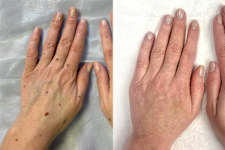 Papillomas Disappear. Try The Virginia Method!