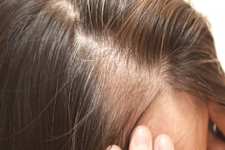 Hair Should Grow Thick! No Matter How Severe The Baldness is