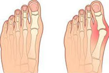 There is an Affordable Way to Correct a Bunion Without Surgery