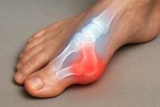 Does Your Bunion Hurt? Here is The Simplest Solution
