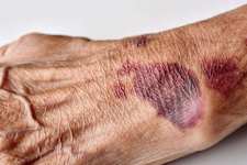  Early Signals of AML Leukemia You Should Definitely Know About (Take a Look)