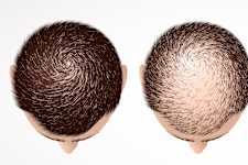 Baldness is Not From Age: Meet The Main Enemy of Hair Loss