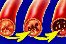 COPD? Simple Trick for Clearing Mucus. Do This Before Bed