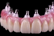 Here is the Cost of One Day Full Mouth Dental Implants in 2024! (See Now!)