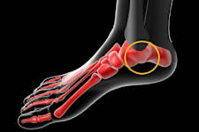 Neuropathic Pain? New Device 'Melts' the Root Cause
