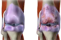 Doctor: Simple Method Ends Joint Pain & Arthritis (Watch)