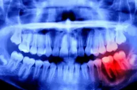 Receding Gums & Tooth Decay? Use This Mineral to Restore Perfect Smile