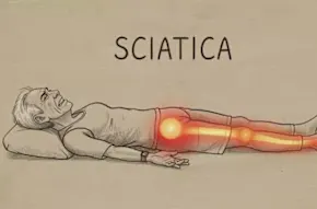 Sciatica is Not From a Slipped Disc. Meet The Real Enemy of Sciatica (Stop This)