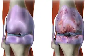 Врач: Простой метод избавляет от болей в суставах и артрита (смотрите видео)