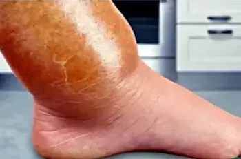 Forget Furosemide, Use This Household Item To Help Drain Edema Fluid