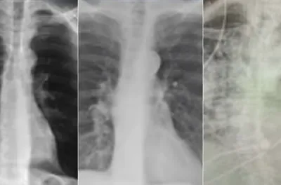 Doctors Stunned: This Will Clear All Mucus From Your Lungs (Watch)