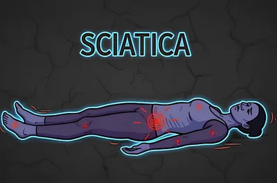 Sciatica Is Not from a Slipped Disc. Meet the Real Enemy of Sciatica (Stop This)