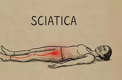 Sciatica is Not From a Slipped Disc. Meet The Real Enemy of Sciatica (Stop This)